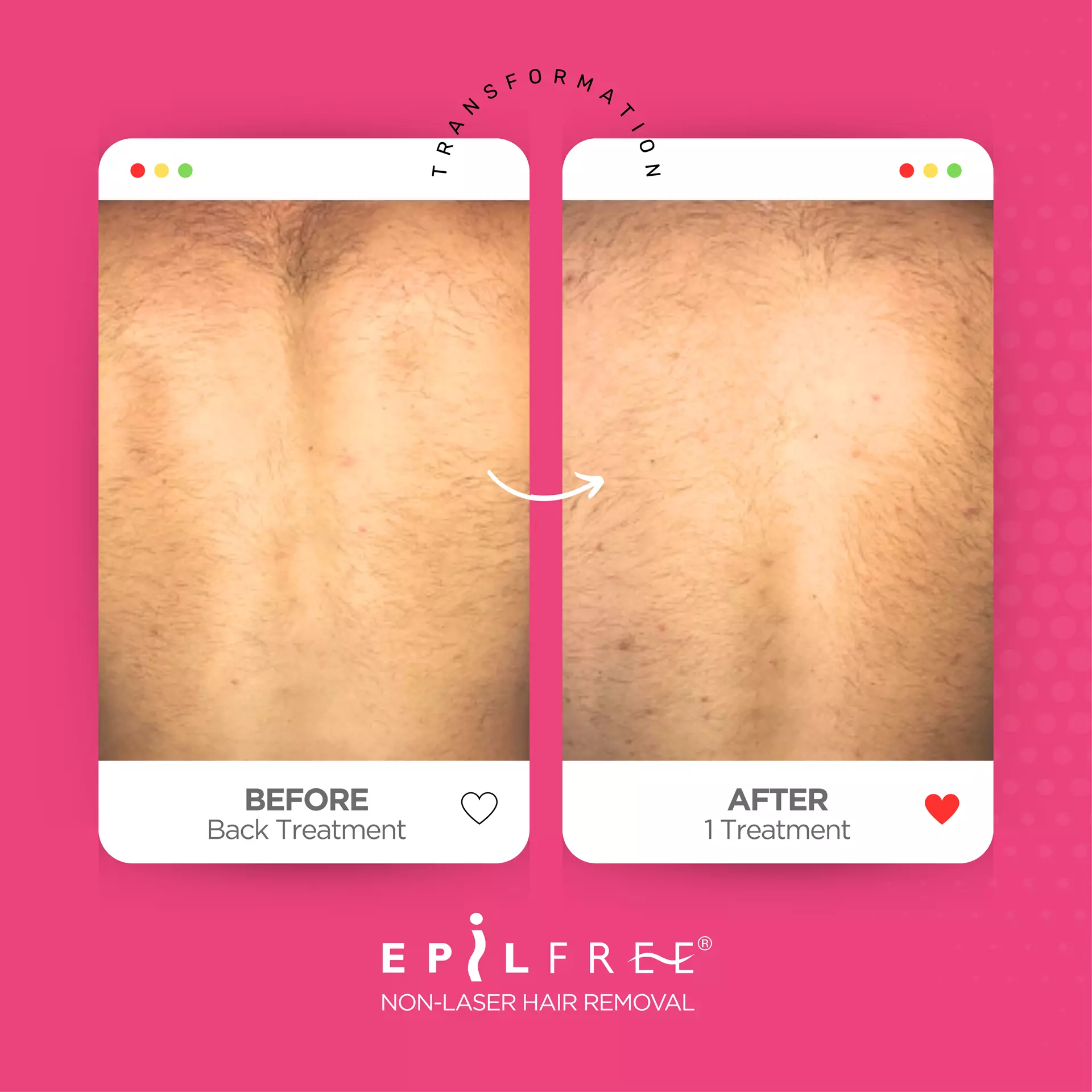 Epilfree
